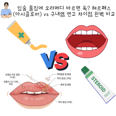 입술 물집에 오라메디 바르면 독? 헤르페스(아시클로버) vs 구내염 연고 차이점 완벽 비교