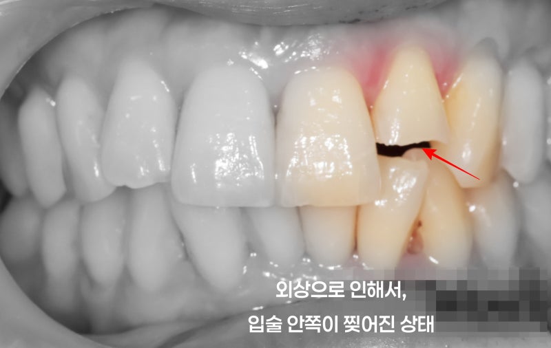 앞니 파절 부러짐 환자, 외상의 경우 어떤식으로 치료를 할 수 있을까요? (탕정치과)