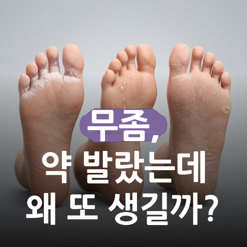 여름마다 발가락 사이가 또 짓무른다면.. 무좀 왜 생기는 걸까, 무좀약 발라도 다시 올라오는....