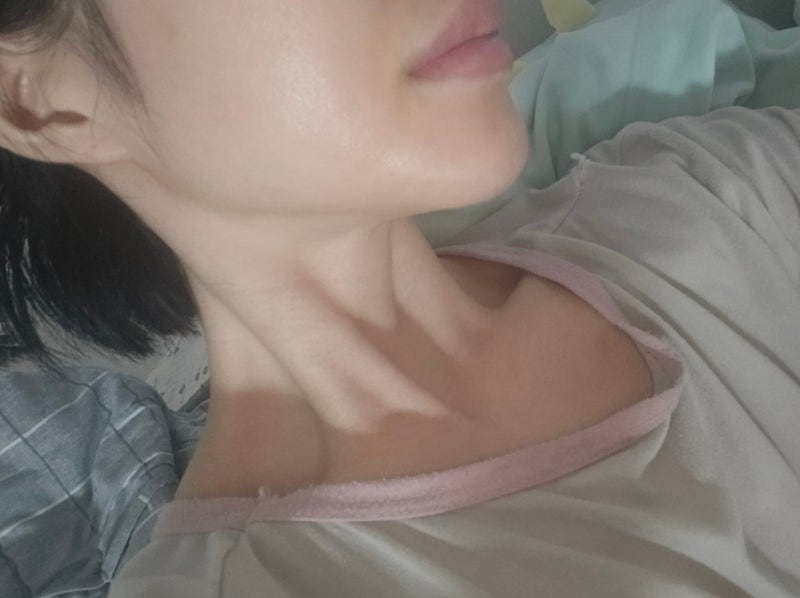 20대후반 울쎄라 수면마취 400샷, ~한달차 후기 통증 효과 ✧•̀.̫•́✧ | 울쎄라 후기 청담 ....