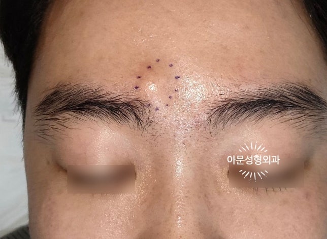 피지낭종 핀홀법, 절개 없이 제거할 수 있을까? 흉터를 줄이는 수술 방법 (서울 강동구 아문....