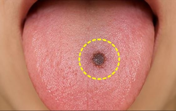 혓바닥 검은점이 갑자기 생겼다면? 구강암과 구별하는 법