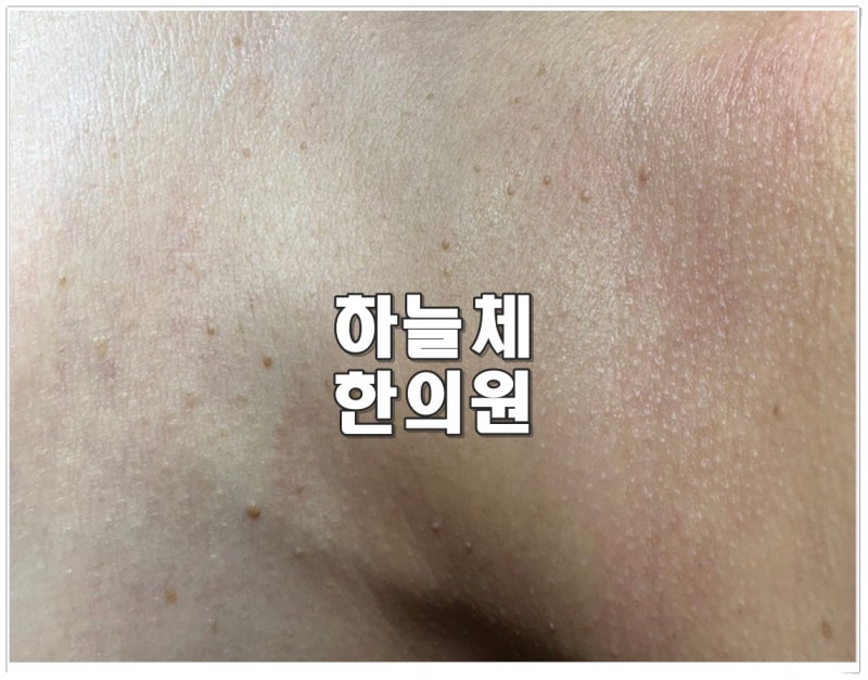 창원편평사마귀 제거, 목 편평사마귀 쥐젖처럼 보여도 같은 방법으로 없애면 될까요?