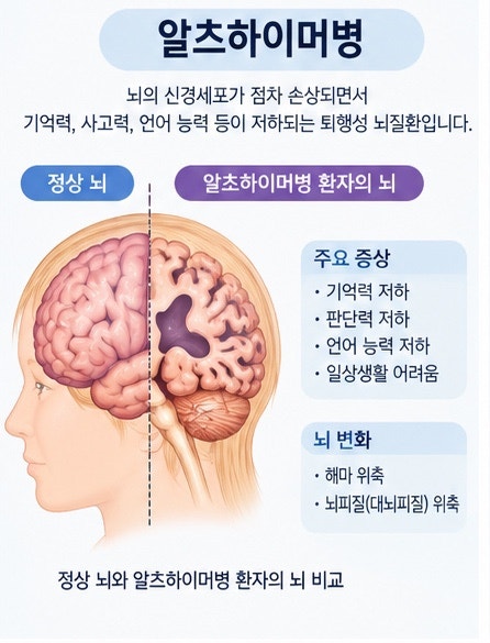 알츠하이머병이란?｜치매의 가장 흔한 원인은 무엇일까