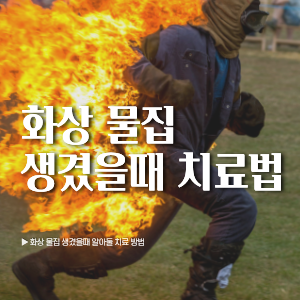 화상 물집 생겼을때 알아둘 치료 방법