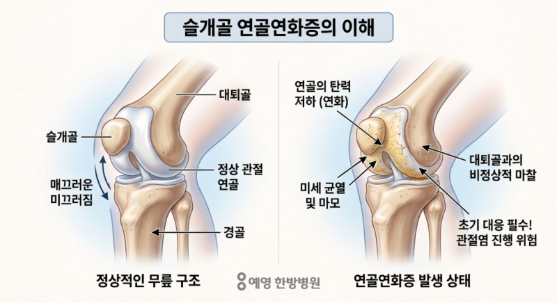 서현동 재활치료한방병원, [무릎 통증] 계단 내려갈 때 찌릿한 무릎 앞쪽 통증, 슬개골 연골....