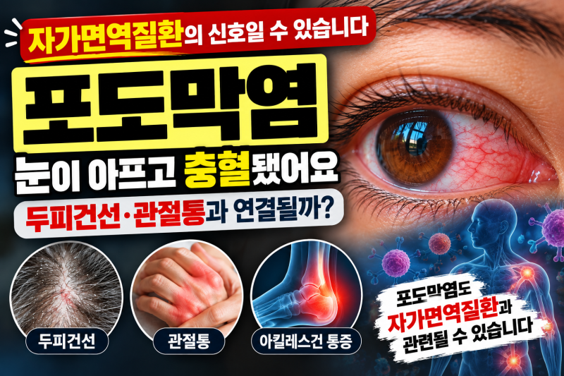 포도막염 증상, 단순한 눈 염증인 줄 알았어요｜두피건선·관절통과 함께 겪은 실제 경험