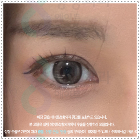쌍커풀재수술 절개쌍수 말고 매몰은 못하나? 재수술 시 가격 얼마?