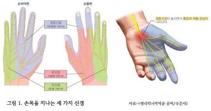 네 번째·새끼손가락이 저리고 손바닥 날 쪽이 무디다면? 팔꿈치 터널 증후군 원인과 이완 운....