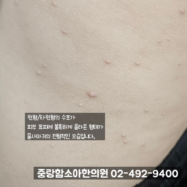 온몸으로 번진 물사마귀는 한약으로 치료합니다. (중랑구 한의원)