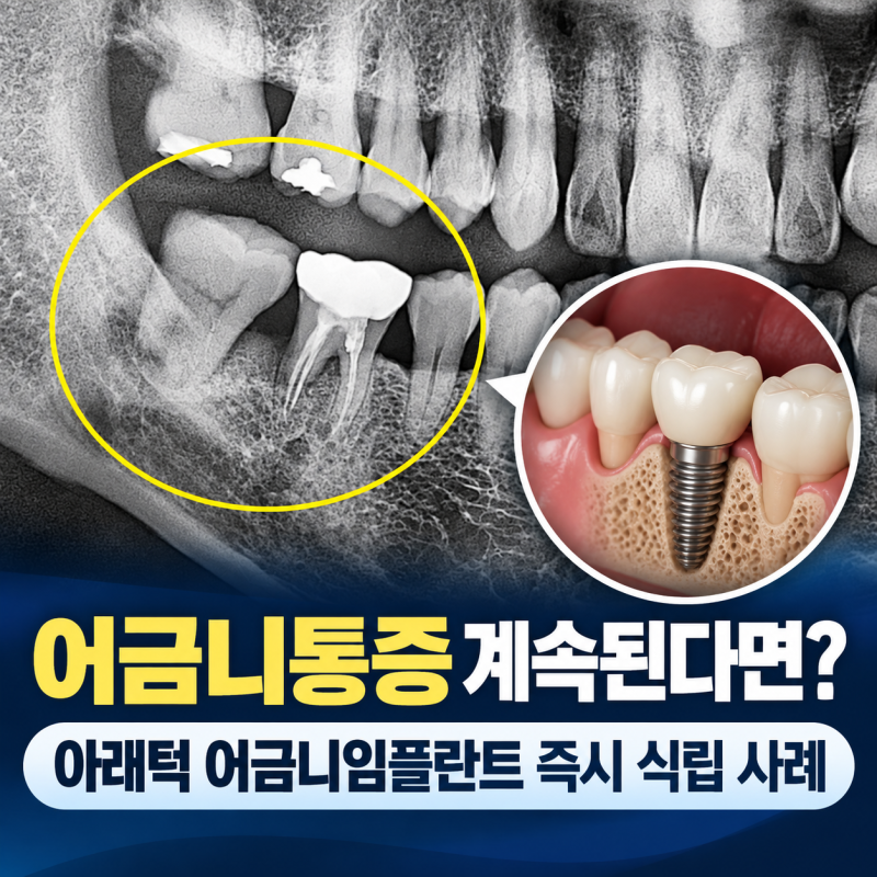 어금니통증 계속된다면? 아래턱 어금니임플란트 즉시 식립 사례
