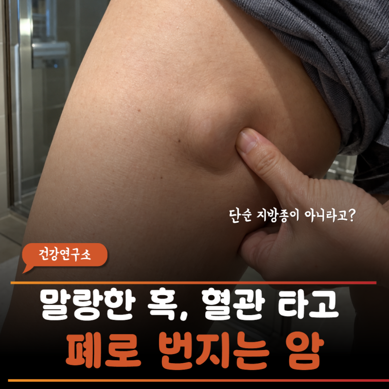 "허벅지에 만져지는 말랑한 혹 지방종인 줄 알았더니…" 근육까지 도려낸 악성 육종암 구별....