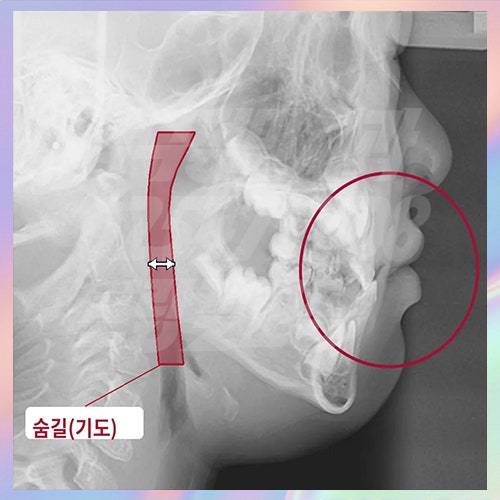 어린이 부정교합 교정은 숨길을 넓혀주고, 키 크는데 도움 줘요