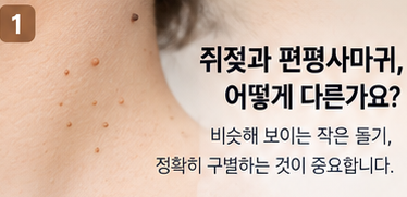 쥐젖과 편평사마귀, 왜 생길까요? 모양부터 관리 방법까지 차이 정리