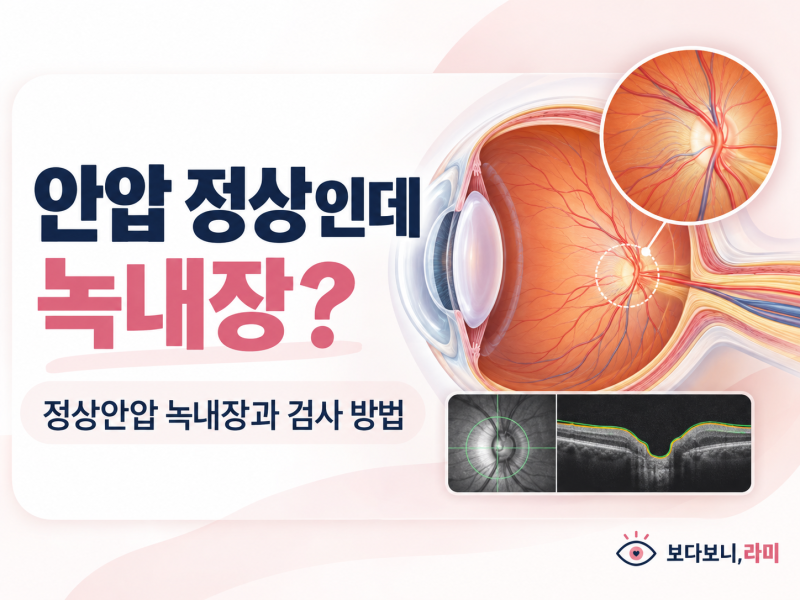 안압 정상인데 녹내장? 정상안압 녹내장 초기증상과 검사 방법