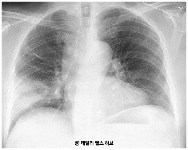 감기·독감과 폐렴 증상 차이 고열·기침·가래로 구분하고 병원 가야 하는 시점