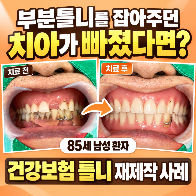 부분틀니를 잡아주던 치아가 빠졌다면?, 85세 건강보험 틀니 재제작 사례