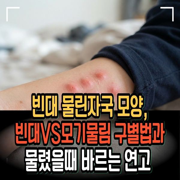 빈대 물린자국 모양, 빈대VS모기물림 구별법과 물렸을때 바르는 연고