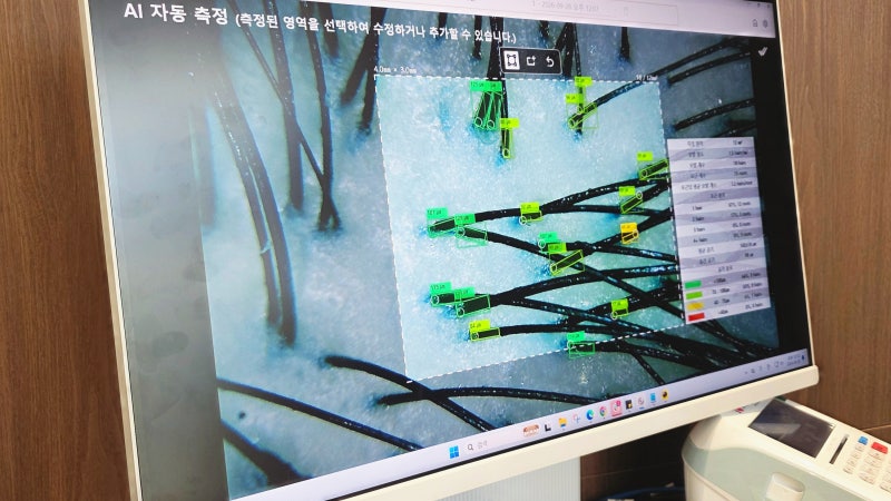 오블리브의원 서울 오리진 종로 탈모두피주사 내돈내산 후기｜모리젠주사 2cc 비용·통증