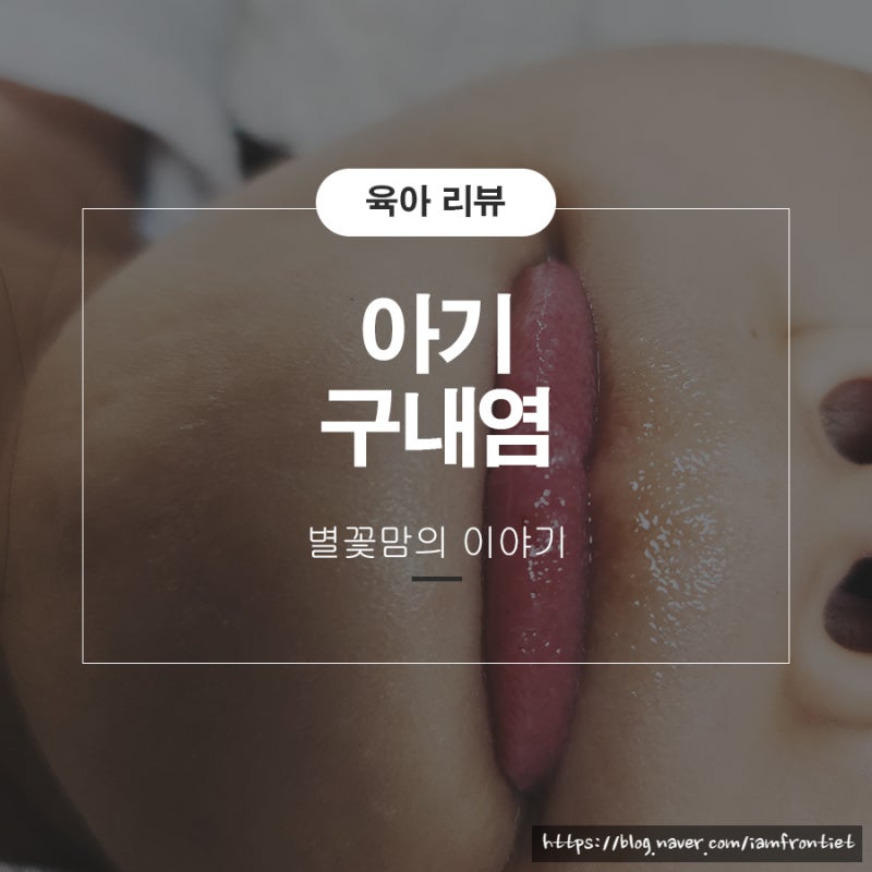 아기 구내염 전염 유아 어린이 관리법