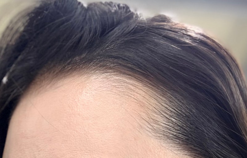 항암 후 하찮은 머리털, 탈모치료제 마이녹실3 내돈 진짜 후기