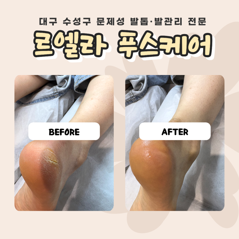 대구 수성구 발각질케어·티눈제거 후기｜르엘라 푸스케어 수성황금점