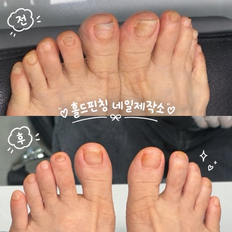 [전주] 홀드핀칭 네일제작소 / 부모님 관리 추천, 엄마 무좀 발톱 교정 후기
