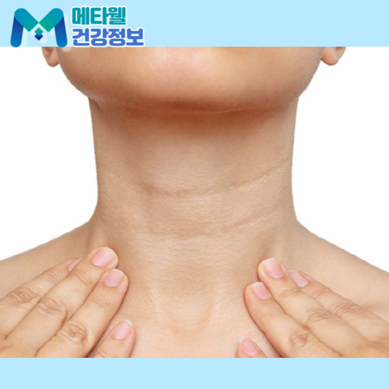 급성후두염 쉰 목소리, 소리가 안 나니 속삭이면 목이 덜 상한다고 생각하셨죠? 속삭임도 성....