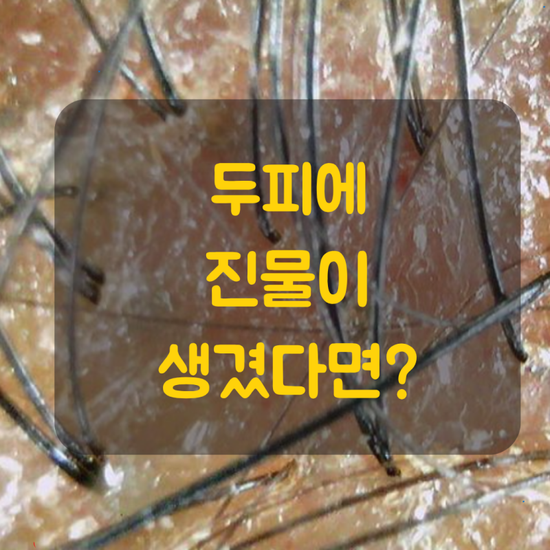 두피에 진물이 생겼다면? 어떻게 관리해야 할까요?