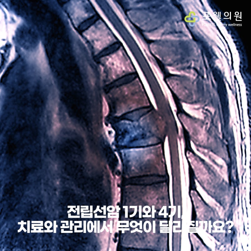 전립선암 1기와 4기, 치료와 관리에서 무엇이 달라질까요?