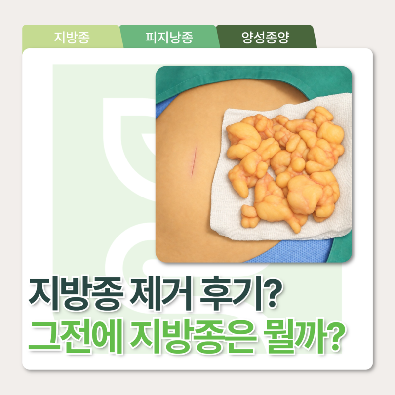 수원지방종 제거 후기 알아보기 전, 지방종에 대해 자세히 알아보기