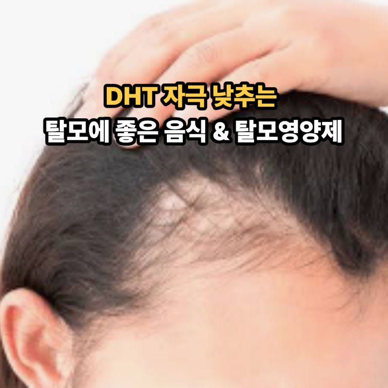 탈모에 좋은 음식과 탈모 영양제 알아보자