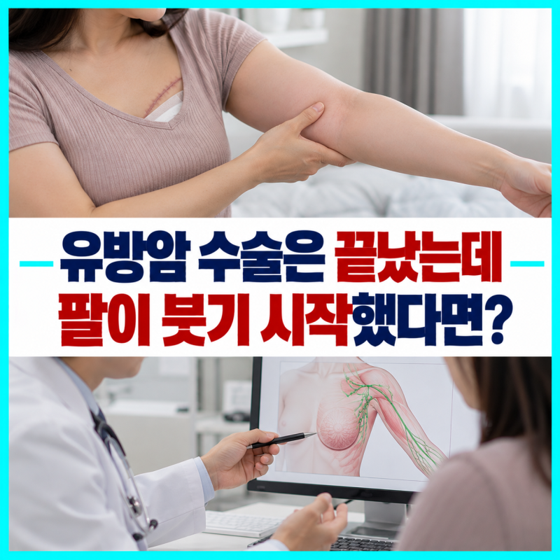 유방암 수술은 끝났는데 팔이 붓기 시작했다면? 림프부종 치료비와 보험의 빈틈