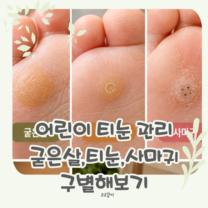 어린이 발바닥 티눈 사마귀 구별, 굳은살과 다른점 알아봐요