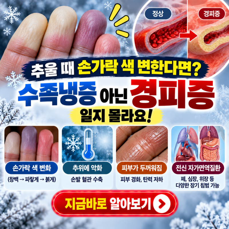 추울 때 손가락 색 변한다면? 수족냉증 아닌 자가면역질환 경피증일지 몰라요!