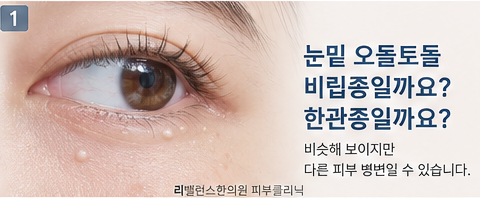 눈밑 오돌토돌, 비립종과 한관종 어떻게 구별할까요? 관리할 때 주의할 점