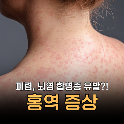 홍역 증상 총정리 원인부터 코플릭 반점, 수두와 차이까지 비교