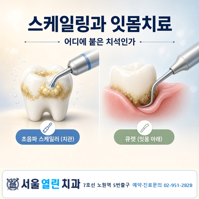 노원 치과 상식 마취 후 진행하는 잇몸치료와 일반 스케일링의 해부학적 차이 총정리 (ft. 서....