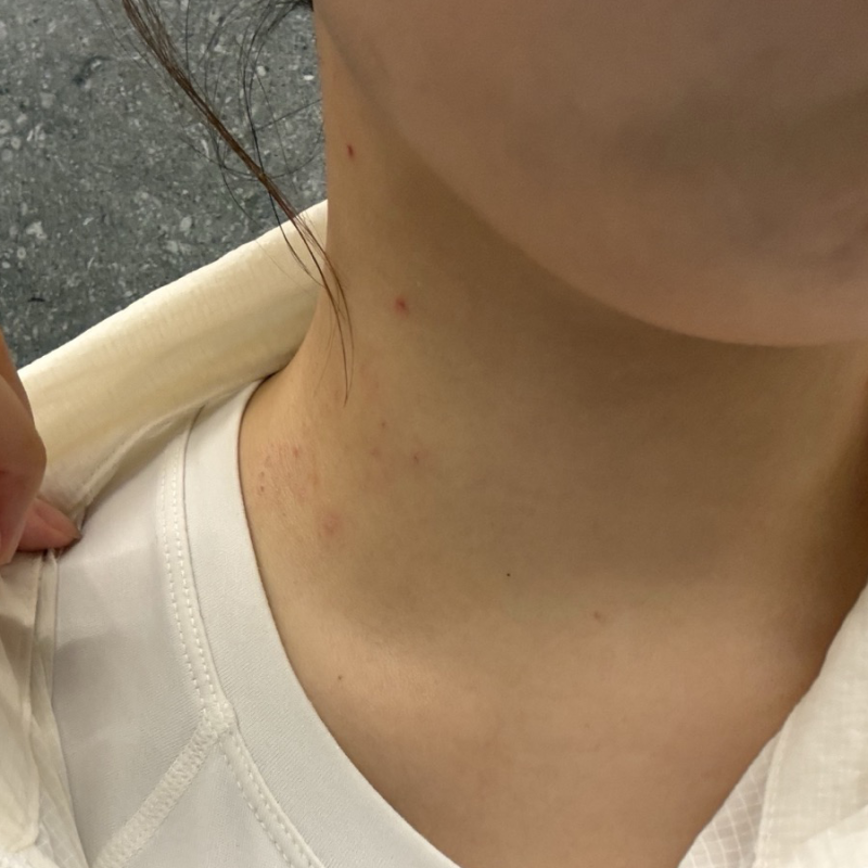 편평사마귀 97개 제거 후기 병원 선택부터 재생테이프·재생크림 관리까지