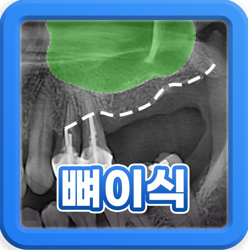 임플란트 뼈이식 후 뼛가루 대처법과 식사 주의할 점?