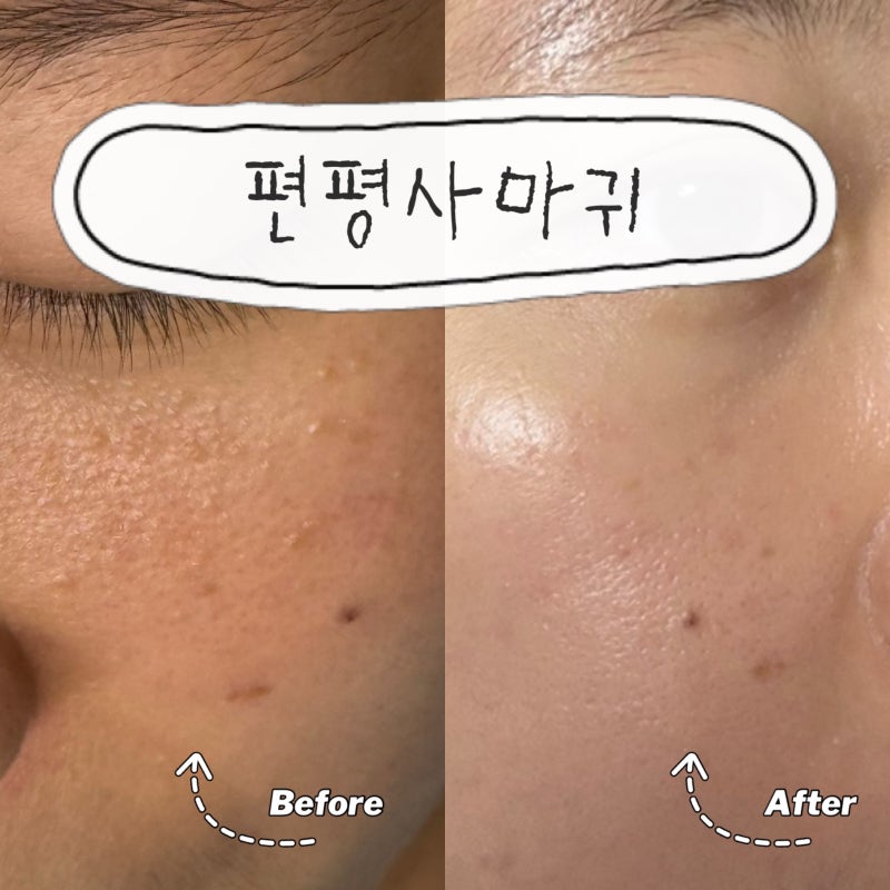 편평사마귀 제거 후기 | 이라의 저점매수