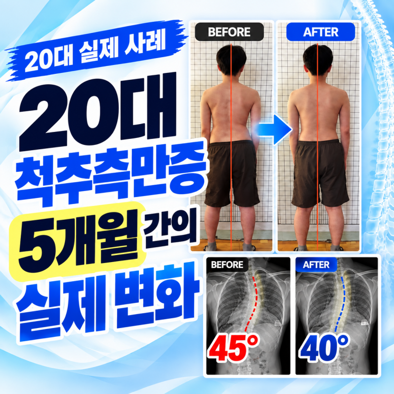 성인 척추측만증, 20대 남성 5개월 후 각도와 체형은 어떻게 달라졌을까?