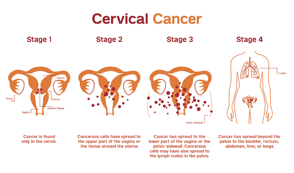 자궁경부암 Cervical cancer: 한 번의 검사가 한 사람의 미래를 바꿀 수 있는 암 II