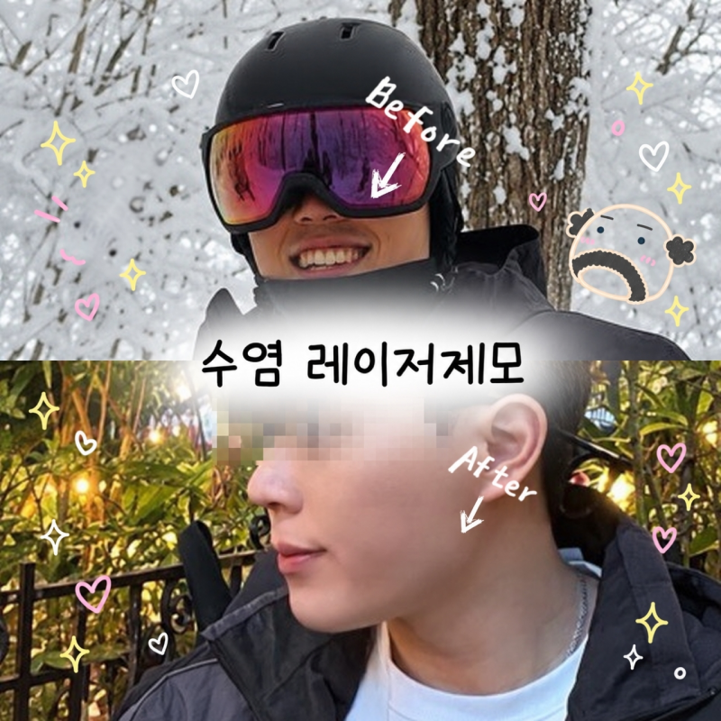 남자 관리 중 돈 안 아깝다는 1순위 통증 덜한 강남 젠틀맥스프로플러스 남자 수염 레이저제....