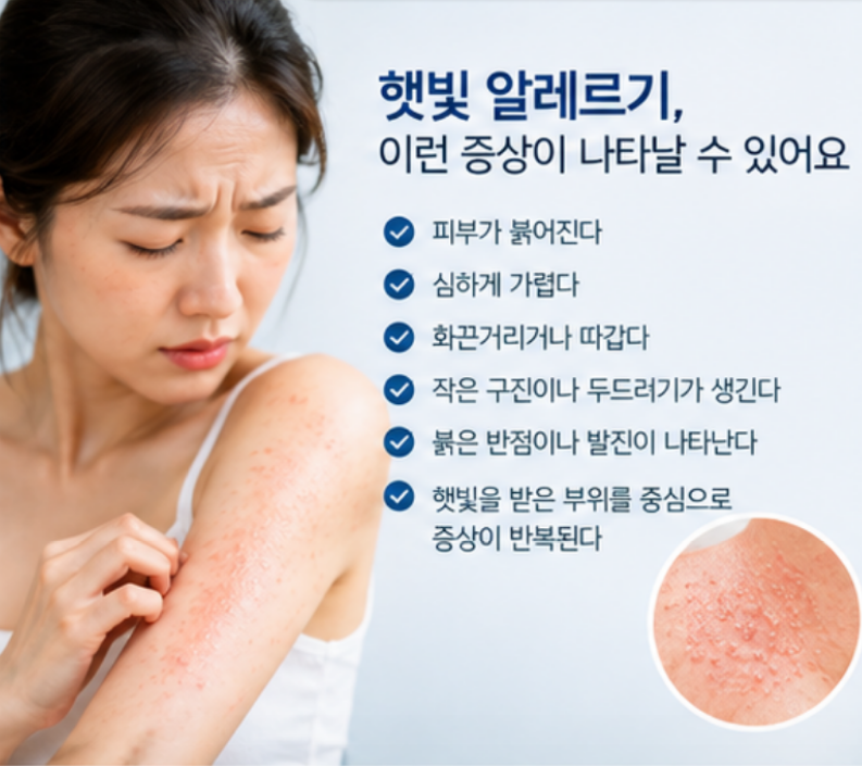 동남아 여행 후 햇빛 알레르기 해결법