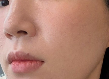 압구정 피부과 여드름 붉은기 안면 홍조 레이저 후기