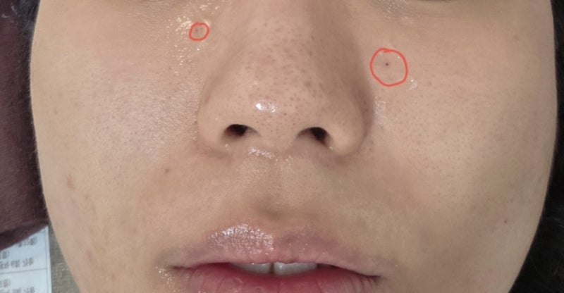 얼굴 빨간점 원인, 체리혈관종 제거 방법 레이저 1일차 5일차 후기 비용