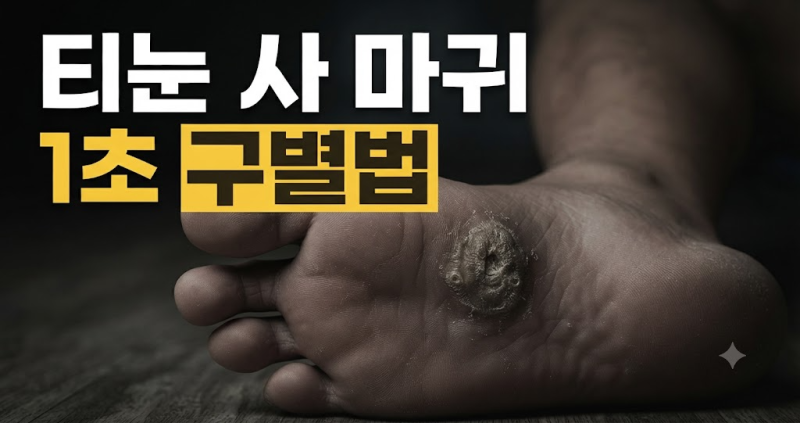 발바닥에 난 게 티눈일까 사마귀일까? 1초 만에 구별하는 확실한 방법