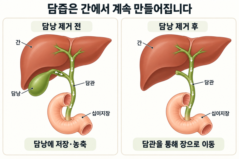 [담낭 제거 수술] 담낭을 제거하면 소화는 어떻게 되나요? 수술 후 식사와 생활 안내