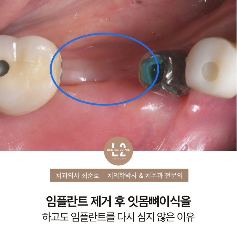 임플란트 제거 후 잇몸뼈이식을 하고도 임플란트를 다시 심지 않은 이유